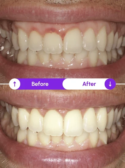 Before and after gum health improvement, Novaalab customer