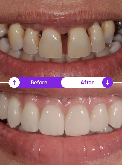 Before and after gum health improvement, Novaalab customer