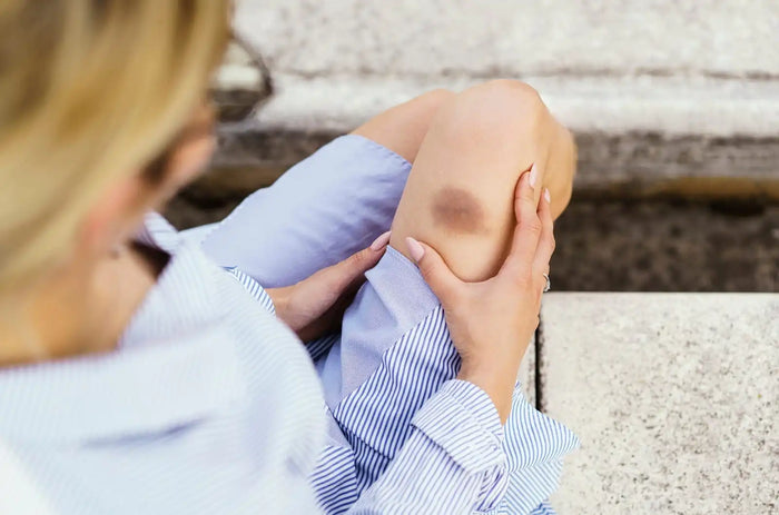 image of woman with bruise on quad