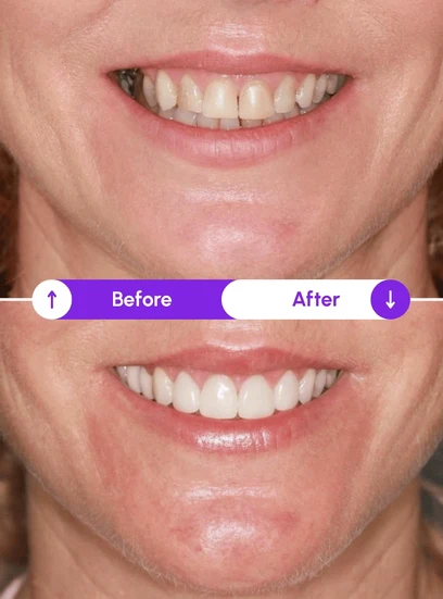Before and after gum health improvement, Novaalab customer