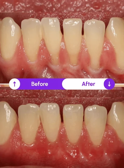 Before and after gum health improvement, Novaalab customer