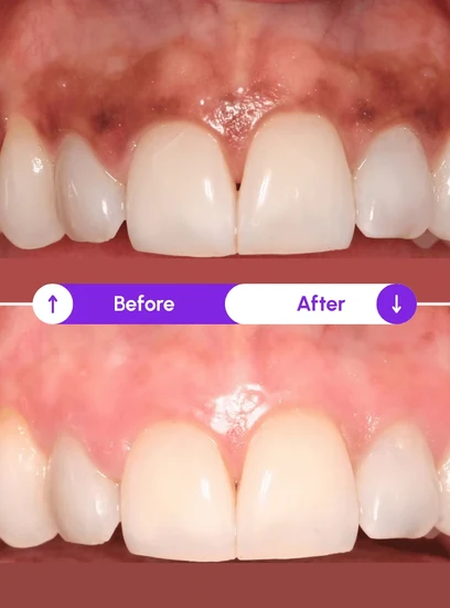Before and after gum health improvement, Novaalab customer