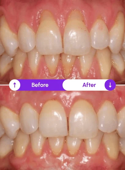 Before and after gum health improvement, Novaalab customer